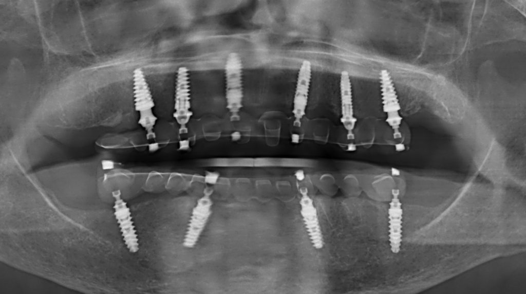 tratamiento de implantes en paciente de 93 años
