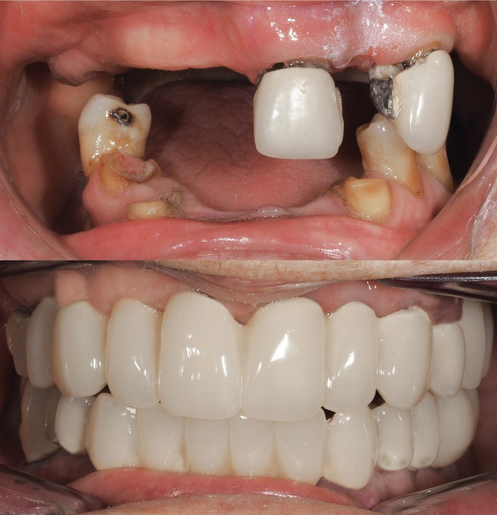 Reconstrucción de dentadura en paciente de 93 años