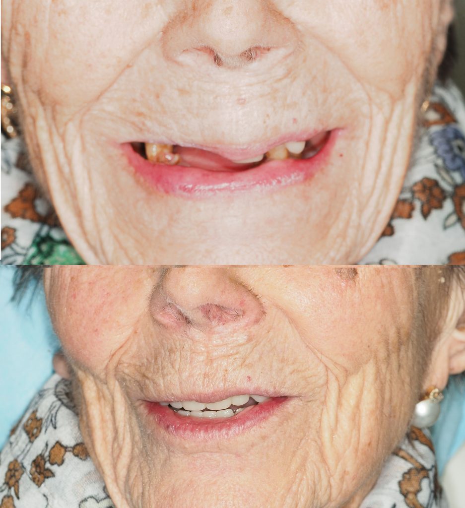 tratamiento de implantes en paciente de 93 años