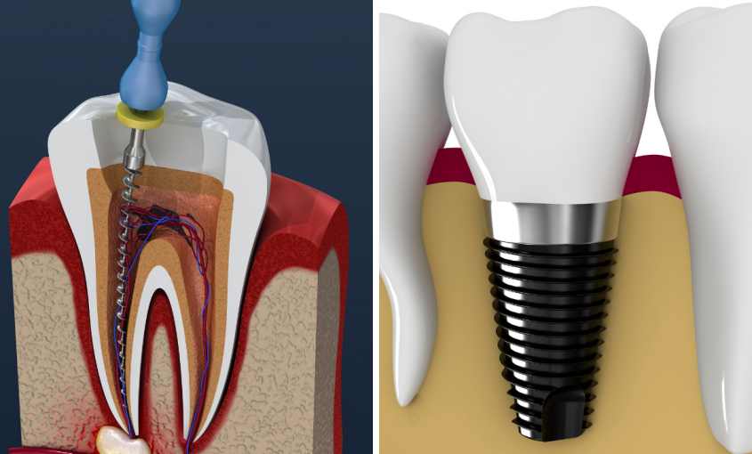 endodoncia o implantes